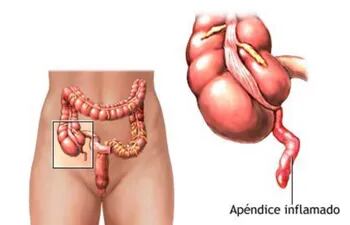 apendicitis-aguda-175007000000-1813103.jpg