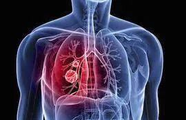 La fibrosis quística afecta a todos aquellos órganos que producen secreciones (pulmones, páncreas, hígado e intestino)