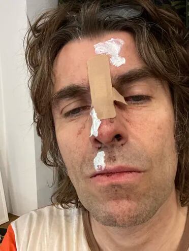Así quedó Liam Gallagher tras caer del helicóptero.