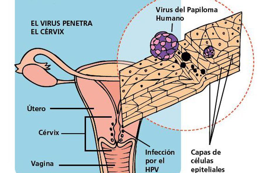 Diagnostico Y Tratamiento De Un Papiloma Solitario De Lengua Reporte De Caso Y Revision De La Literatura