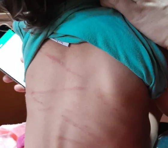 La niña de dos años tiene varias heridas en la espalda.