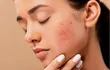 El acné se pueden presentar clínicamente como lesiones no inflamatorias (comedones abiertos y cerrados) y lesiones inflamatorias (granos rojos, con pus, nodulares y quísticos) todo esto acompañado de una piel más oleosa.