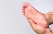La enfermedades de manos, pies y boca es más frecuente en niños pero los adultos también pueden contagiarse, ser reservorios y trasmitir el virus.