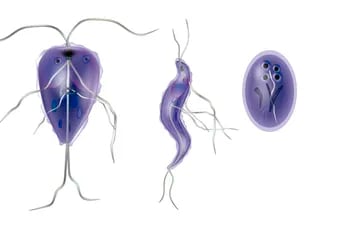 Infección causada por un parásito llamado Giardia lamblia.