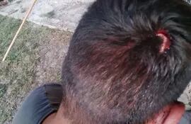 Una de las víctimas de la supuesta tortura de parte de guardias de una estancia muestra la herida recibida en la cabeza