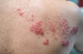 Las erupciones en la piel son los síntomas más conocidos de la varicela.