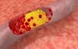 nanodrones-podrian-ser-utilizados-para-eliminar-las-placas-de-colesterol-acumuladas-en-las-arterias-foto-redorbit-com-202352000000-1297792.jpg