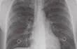 aunque-sin-cura-definitiva-los-sintomas-de-la-llamada-enfermedad-pulmonar-obstructiva-cronica-epoc-pueden-ser-controlados-para-mejorar-la-calidad-d-02801000000-1493854.jpg