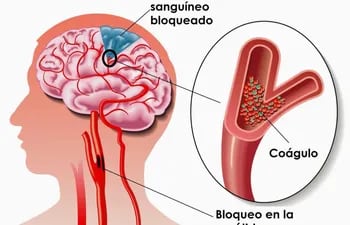la-trombosis-venosa-se-produce-por-la-obstruccion-del-riego-sanguineo-cerebral-efectuado-por-un-coagulo-o-trombo-entonces-el-cerebro-queda-sin-aporte-202029000000-1524057.jpg