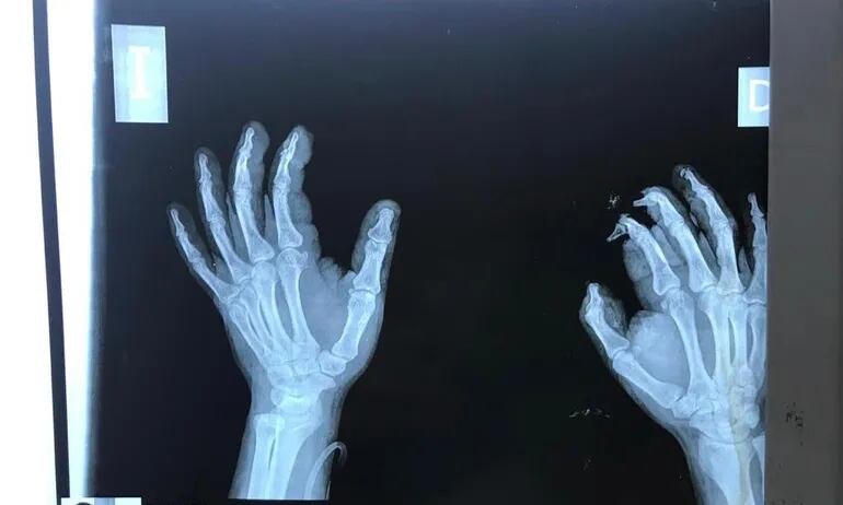 Radiografía de las manos de uno de los niños que sufrió heridas por la explosión de un cebollón. Se puede observar que las puntas de los primeros tres dedos del lado derecho se encuentran prácticamente carcomidos.