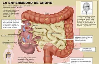 enfermedad-de-crohn-180438000000-1715079.jpg