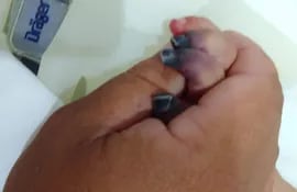 Cuatro dedos de la pequeña está con necrocis.