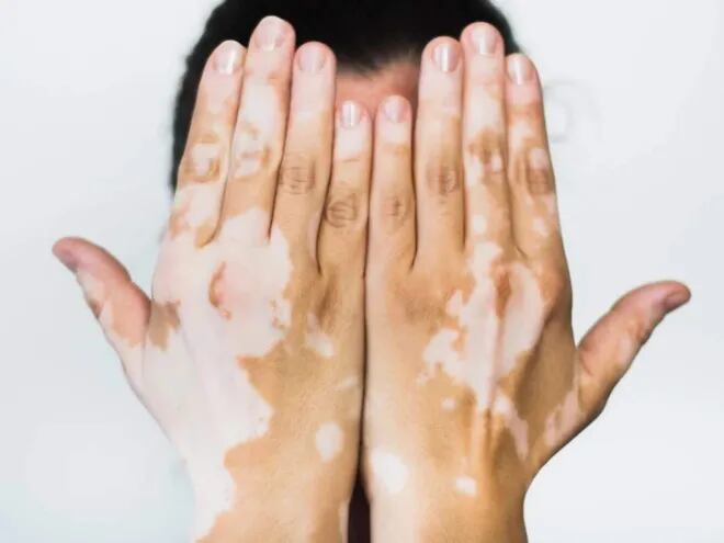 El vitiligo es una enfermedad autoinmune, es la pérdida irregular del color de la piel que suele aparecer en manos y rostro. La afección no es contagiosa ni pone en riesgo la vida de quien la padece.
