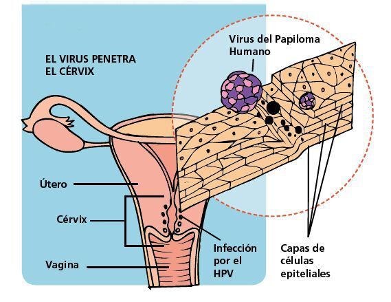 Papiloame și condiloame în vagin