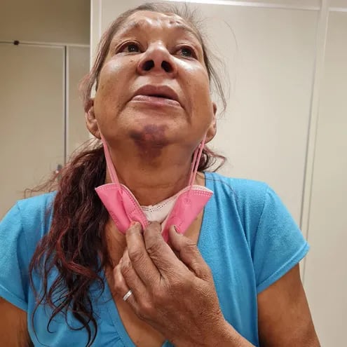 María Mercedes González Ocampos (52) mostró los hematomas tras ser supuestamente golpeada por agentes policiales.