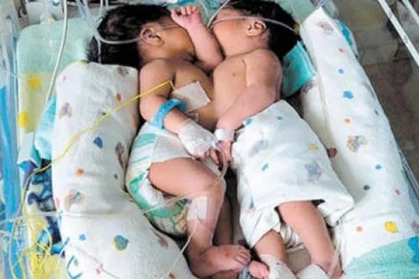 La imagen es ilustrativa, pero según indicaron los médicos, de esta manera nacieron los siameses que están internados en el Hospital de Clínicas.