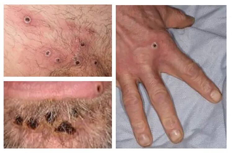 Un collage de las lesiones causadas por la Viruela del Mono, compiladas por la Agencia de Seguridad Sanitaria del Reino Unido.