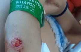 Una joven atacada por pirañas en la Playa Bella Vista, el sábado uno de enero, muestra una considerable herida recibida en la mano.