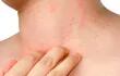 Vivir con dermatitis atópica es vivir con picazón constante, con una intensidad que varía de una persona a otra, según la cantidad de piel afectada.
