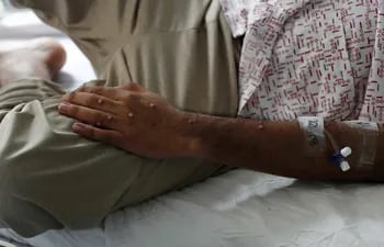 Imagen de referencia sobra la viruela del mono: un paciente es atendido tras ser diagnosticado con la viruela símica en Lima, capital de Perú.