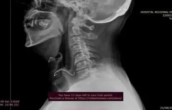 La placa obtenida por rayos publicada en la página del hospital regional muestra el objeto extraño incrustado en la zona de la hipofaringe. El paladar fue extraído mediante un procedimiento de endoscopía.