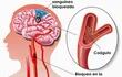 la-trombosis-venosa-se-produce-por-la-obstruccion-del-riego-sanguineo-cerebral-efectuado-por-un-coagulo-o-trombo-entonces-el-cerebro-queda-sin-aporte-202029000000-1524057.jpg