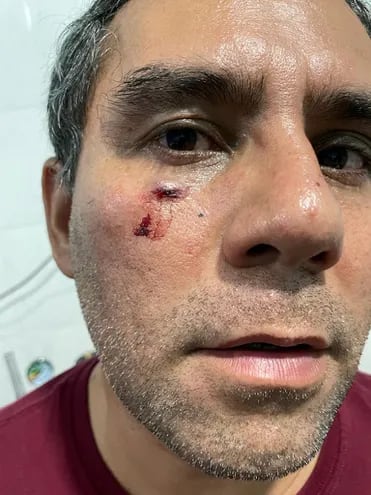 Marcos Andino muestra rastros de la agresión que sufrió anoche supuestamente por un grupo de liberales.