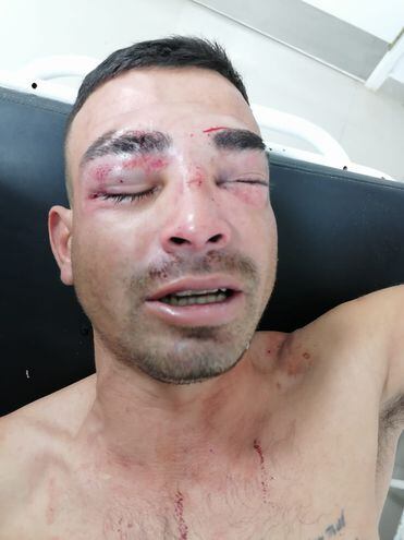 La victima Jose Miguel Insaurralde victima de la agresion y tras recibir la asistencia en el hospital