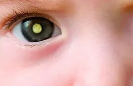 El retinoblastoma es el cáncer intraocular más frecuente en la infancia que puede aparecer hasta los 5 años de edad aproximadamente, su incidencia varía de 1 caso en 15000 a 20000 nacidos vivos a nivel mundial.