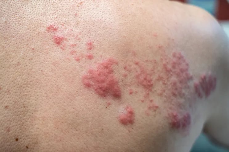 Las erupciones en la piel son los síntomas más conocidos de la varicela.