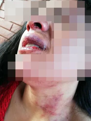 Mujer agredida por su pareja, según una denuncia ante la Policía.