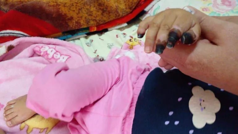 La niña Melody sufrió una necrosis de punta de dedo, en este caso, en cuatro de la mano.