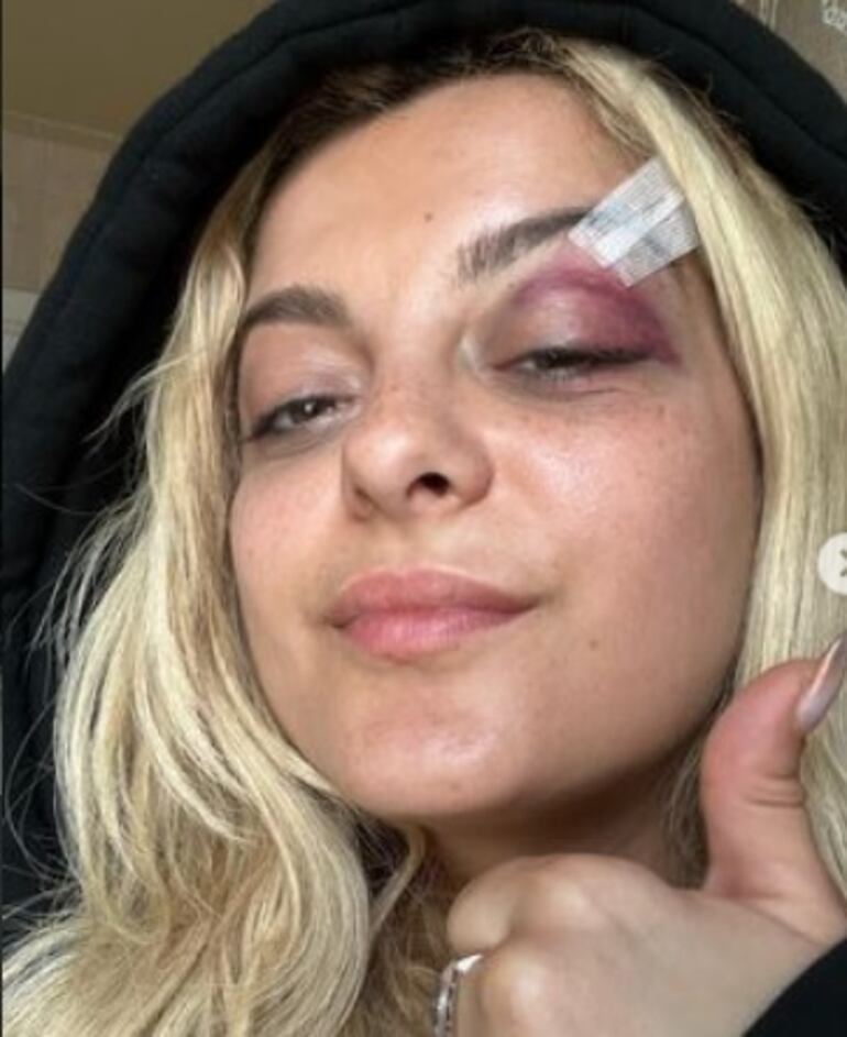 La cantante Bebe Rexha compartió una fotografía en su cuenta de Instagram donde se observa el hematoma provocado en su ojo y la herida que debió ser suturada.