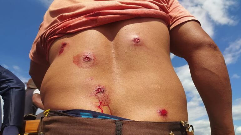 Una persona herida con balines de goma durante el enfrentamiento en zona de Lusipar.