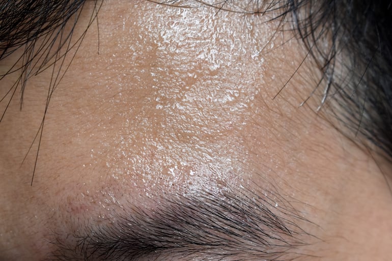 Hiperhidrosis o sudoración excesiva.
