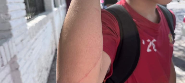 Niño con camiseta roja y brazo herido en primer plano, fondo de pared blanca, luces naturales del exterior.
