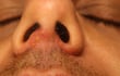 Herpes simple tipo 1.