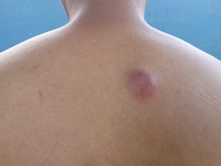 Forúnculo. Imagen ilustrativa.