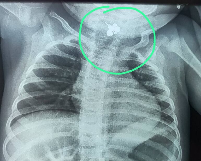 Radiografía de una pequeña de 10 meses, donde se ve un arito atascado en la faringolaringe.