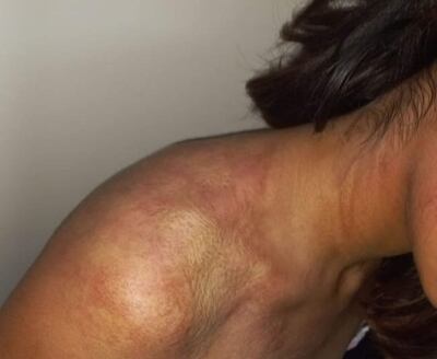 La adolescente presenta rastros de violencia física en varias partes del cuerpo