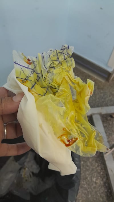 Bolsa colectora de orina, ya en estado de descomposición, que extrajeron de la herida de doña Victorina, quien se operó en octubre en el Hospital Regional IPS de Ciudad del Este.