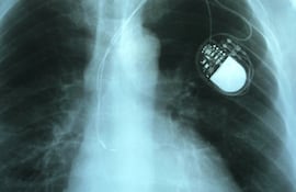 Concepto de marcapasos.