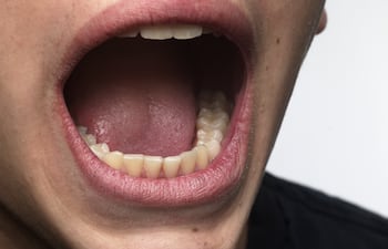 ¿Puede el microbioma bucal predecir cáncer?