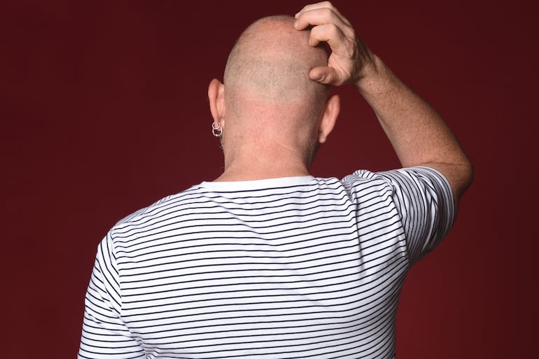 Día Mundial del Pelado: ¿por qué algunas personas se quedan calvas y otras no?