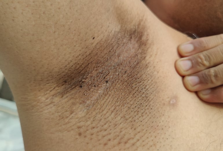 Resistencia a la insulina, obesidad o acantosis nigricans, imagen ilustrativa.