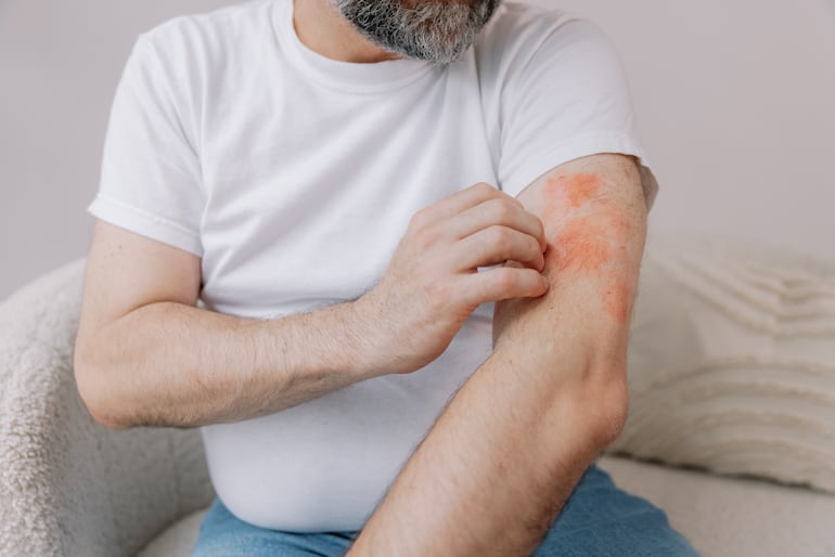 Concepto de problemas de la piel, dermatitis, eccema, etcétera.