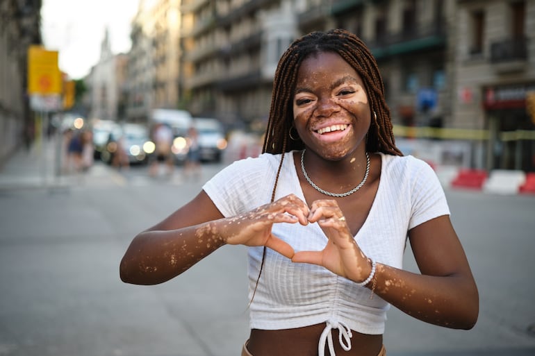 Vitiligo.