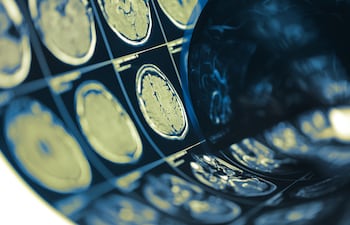 Accidente Cerebro Vascular (ACV)