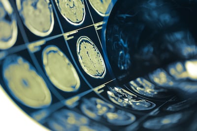 Accidente Cerebro Vascular (ACV)
