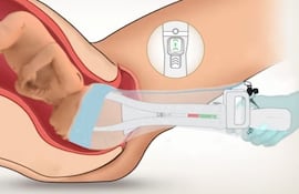 OdonAssist, herramienta para partos.
